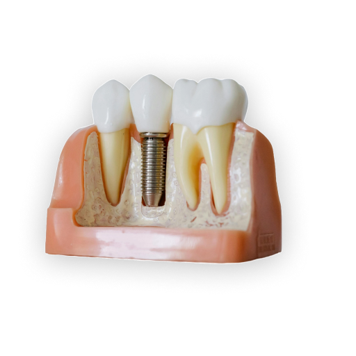 Dental Implant