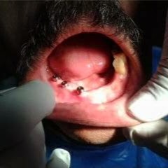 Implant placement 1
