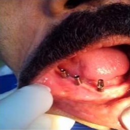Implant placement 2