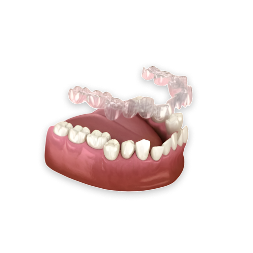 Invisible-Braces